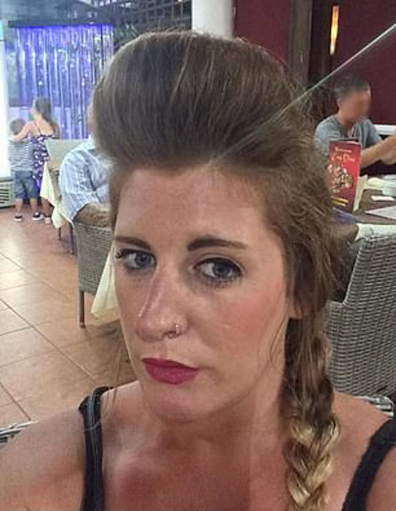 صور صادمة لامرأة بعد عملية نفخ شفاه منخفضة الكلفة صورة رقم 5