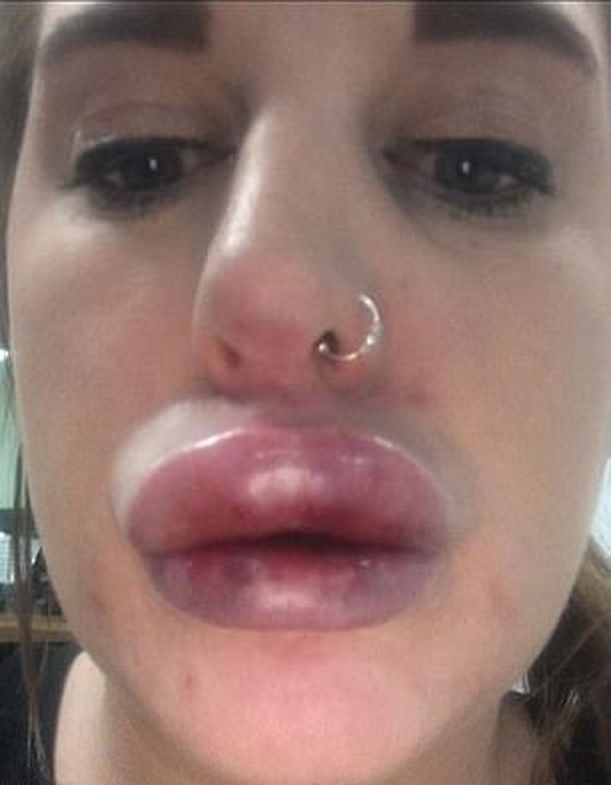 صور صادمة لامرأة بعد عملية نفخ شفاه منخفضة الكلفة صورة رقم 4