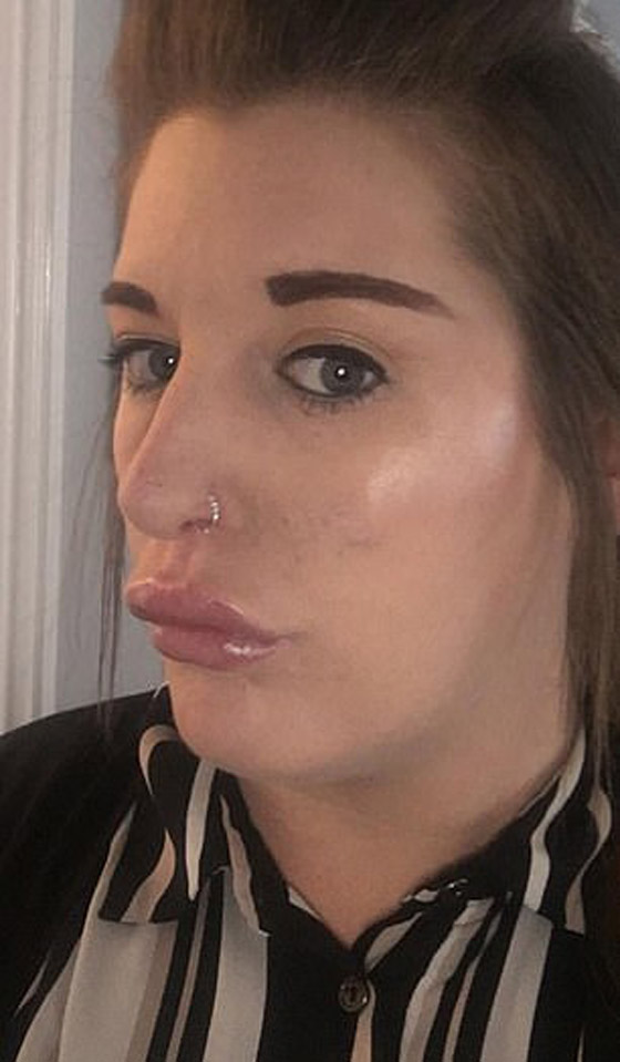 صور صادمة لامرأة بعد عملية نفخ شفاه منخفضة الكلفة صورة رقم 1