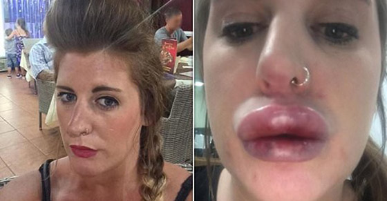 صور صادمة لامرأة بعد عملية نفخ شفاه منخفضة الكلفة صورة رقم 2
