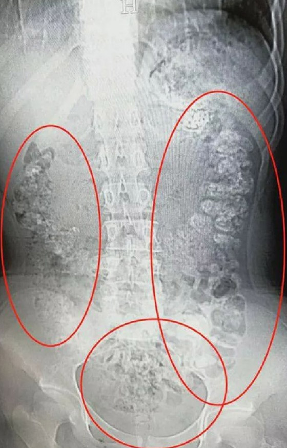 اكتشاف أكثر من 100 حبة كرات شاي التابيوكا داخل أحشاء مراهقة صينية! صورة رقم 3