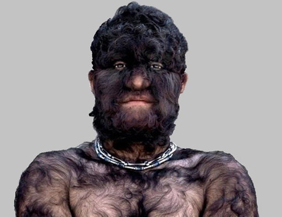 إليكم 10 من أغرب الحالات الطبية والاضطرابات العقلية والجسدية النادرة صورة رقم 8 إليكم 10 من أغرب الحالات الطبية والاضطرابات العقلية والجسدية النادرة صورة رقم 8