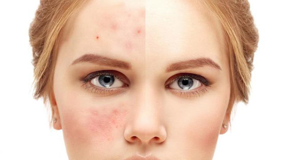 عادات يومية يمكن أن تمنع ظهور حب الشباب صورة رقم 4