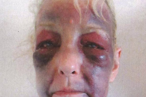 ضربها صديقها وشوهها.. فانتقمت وسجنته 7 سنوات! صورة رقم 3