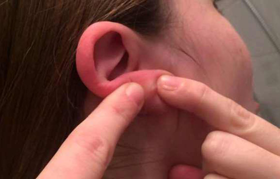 ليس كما تظن.. احمرار الأذن حالة طبية يجب علاجها.. وهذه الأسباب! صورة رقم 11