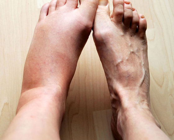 أبرزها ألم الذراع.. 8 أعراض وعلامات لأمراض ومشاكل في القلب صورة رقم 3