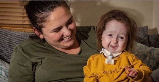 بالصور: طفلة في عمر سنتين بملامح عجوز.. تعرفوا على السر صورة رقم 10