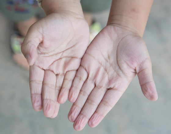 ما سبب تجعد الأصابع وانكماشها عند تعرضها للماء؟ صورة رقم 1