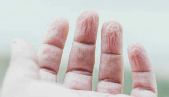 ما سبب تجعد الأصابع وانكماشها عند تعرضها للماء؟ صورة رقم 8