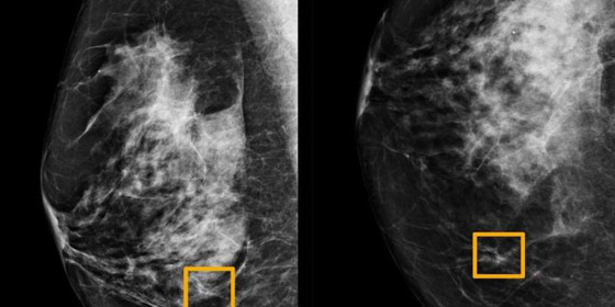 غوغل تدخل على خط اكتشاف سرطان الثدي صورة رقم 4