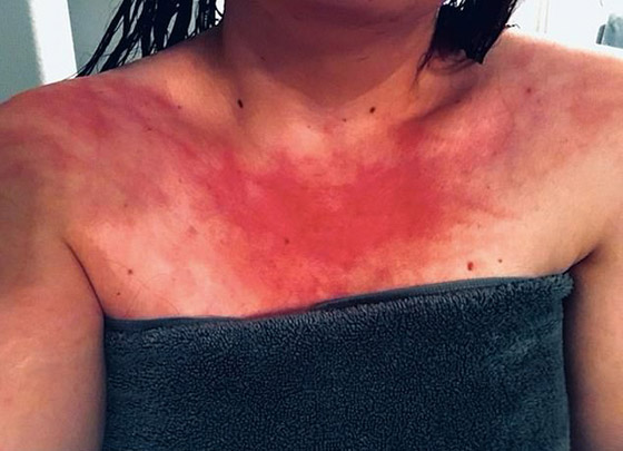 هل سمعت بمرض حساسية الماء؟ فتاة تعاني كلما استحمت أو غسلت يديها! صورة رقم 1