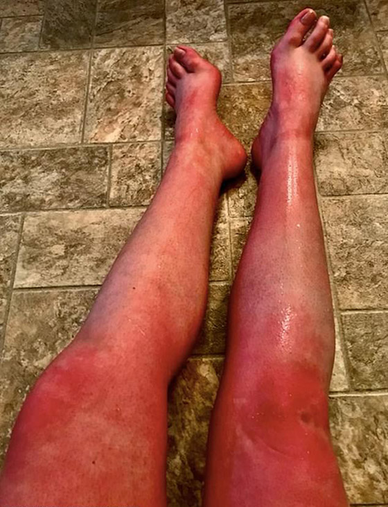 هل سمعت بمرض حساسية الماء؟ فتاة تعاني كلما استحمت أو غسلت يديها! صورة رقم 2