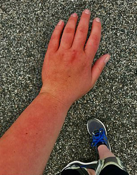 هل سمعت بمرض حساسية الماء؟ فتاة تعاني كلما استحمت أو غسلت يديها! صورة رقم 4