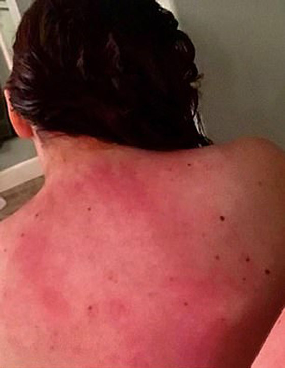 هل سمعت بمرض حساسية الماء؟ فتاة تعاني كلما استحمت أو غسلت يديها! صورة رقم 5