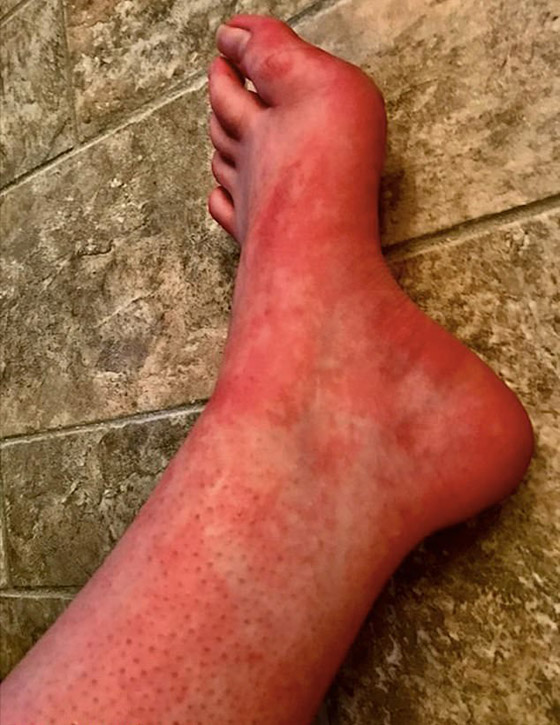 هل سمعت بمرض حساسية الماء؟ فتاة تعاني كلما استحمت أو غسلت يديها! صورة رقم 6