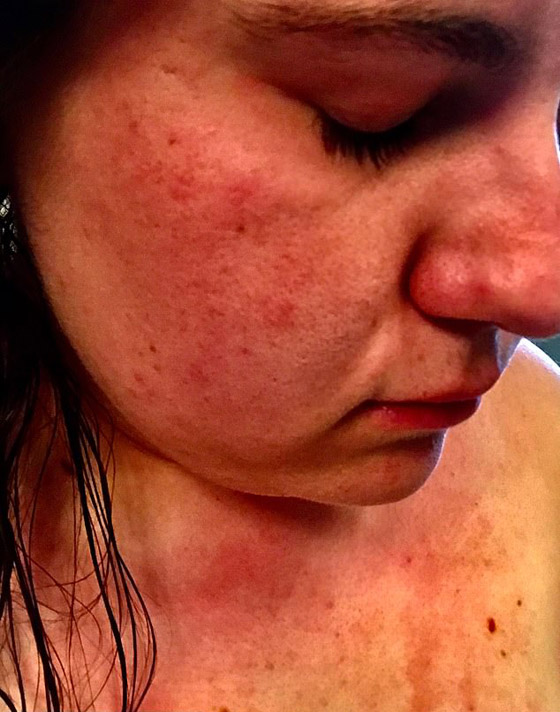 هل سمعت بمرض حساسية الماء؟ فتاة تعاني كلما استحمت أو غسلت يديها! صورة رقم 7