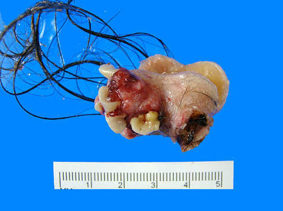 بالصور: تعرفوا على الكائنات الحية التي تعيش بداخل جسم الإنسان! صورة رقم 13 بالصور: تعرفوا على الكائنات الحية التي تعيش بداخل جسم الإنسان! صورة رقم 13