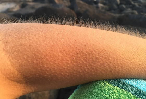 أخيرا توصّل العلم إلى تفسير للظاهرة: لماذا نصاب بالقشعريرة؟! صورة رقم 7