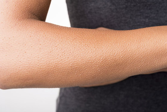 أخيرا توصّل العلم إلى تفسير للظاهرة: لماذا نصاب بالقشعريرة؟! صورة رقم 4