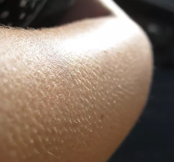 أخيرا توصّل العلم إلى تفسير للظاهرة: لماذا نصاب بالقشعريرة؟! صورة رقم 9