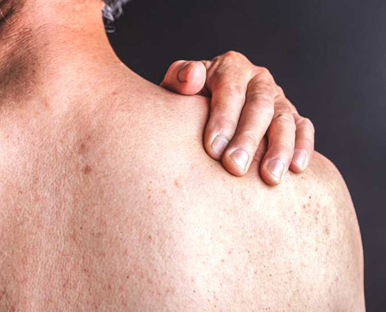 تعرفوا على أسباب الصدفية، أنواعها وأعراضها، طرق علاجها ومضاعفاتها صورة رقم 12 تعرفوا على أسباب الصدفية، أنواعها وأعراضها، طرق علاجها ومضاعفاتها صورة رقم 12