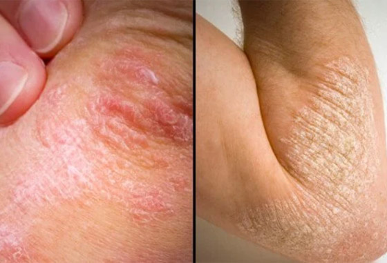 تعرفوا على أسباب الصدفية، أنواعها وأعراضها، طرق علاجها ومضاعفاتها صورة رقم 15 تعرفوا على أسباب الصدفية، أنواعها وأعراضها، طرق علاجها ومضاعفاتها صورة رقم 15