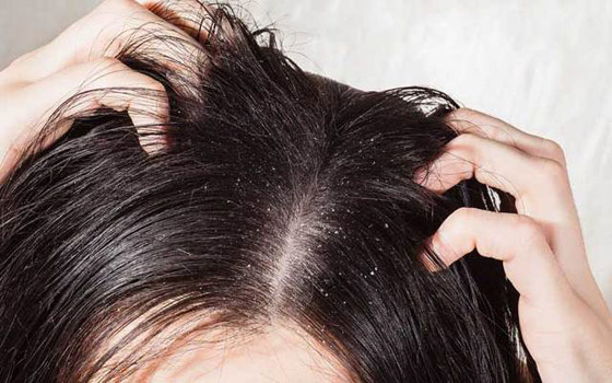 تجنبوا تناول هذه الأطعمة لحماية شعركم من القشرة وإحراجها! صورة رقم 4