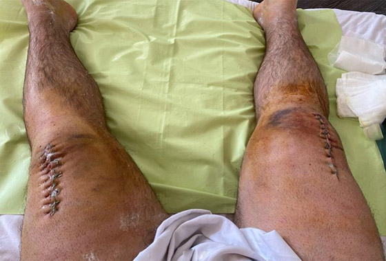 رياضي روسي ينهار وتنكسر ركبتاه أثناء محاولته رفع 400 كيلوغرام أثقال صورة رقم 9 رياضي روسي ينهار وتنكسر ركبتاه أثناء محاولته رفع 400 كيلوغرام أثقال صورة رقم 9