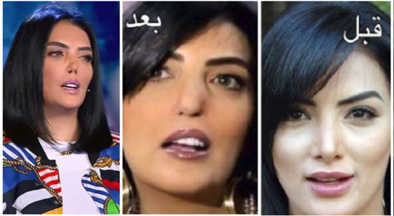 هكذا شوّهت عمليات التجميل هؤلاء المشاهير.. بينهم عرب (صور) صورة رقم 1