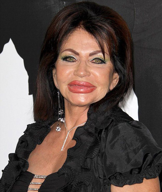 هكذا شوّهت عمليات التجميل هؤلاء المشاهير.. بينهم عرب (صور) صورة رقم 4