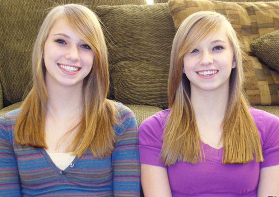 صور: تعرفوا إلى 6 من أغرب أنواع التوائم وأندرها في العالم صورة رقم 3