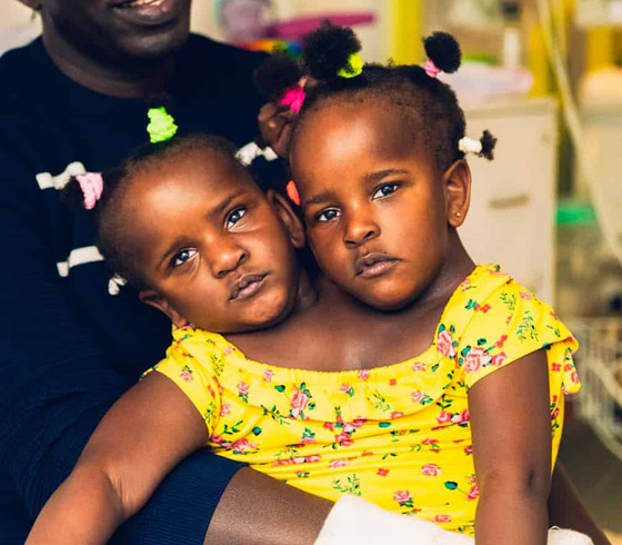 صور: تعرفوا إلى 6 من أغرب أنواع التوائم وأندرها في العالم صورة رقم 5