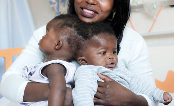 صور: تعرفوا إلى 6 من أغرب أنواع التوائم وأندرها في العالم صورة رقم 6