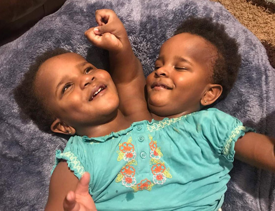 صور: تعرفوا إلى 6 من أغرب أنواع التوائم وأندرها في العالم صورة رقم 7