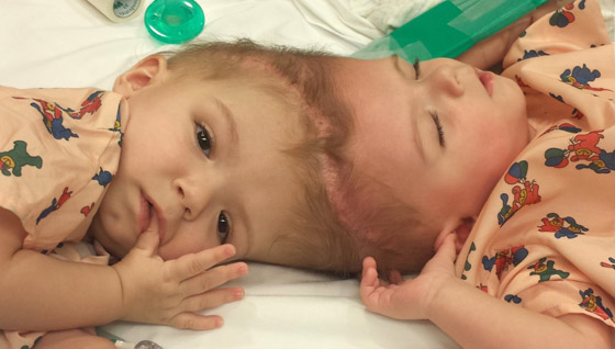 صور: تعرفوا إلى 6 من أغرب أنواع التوائم وأندرها في العالم صورة رقم 8