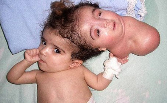 صور: تعرفوا إلى 6 من أغرب أنواع التوائم وأندرها في العالم صورة رقم 10