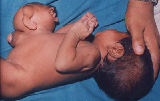 صور: تعرفوا إلى 6 من أغرب أنواع التوائم وأندرها في العالم صورة رقم 9