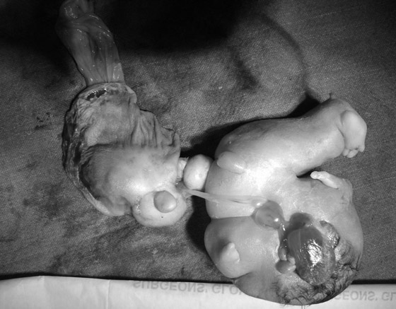 صور: تعرفوا إلى 6 من أغرب أنواع التوائم وأندرها في العالم صورة رقم 12