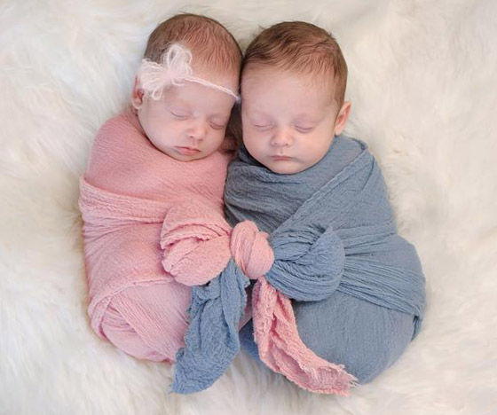 صور: تعرفوا إلى 6 من أغرب أنواع التوائم وأندرها في العالم صورة رقم 16