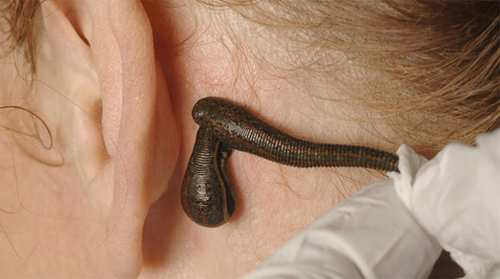 تعرفوا إلى أغرب 10 علاجات وإجراءات طبية اتبعها الأطباء حول العالم صورة رقم 3