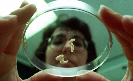 تعرفوا إلى أغرب 10 علاجات وإجراءات طبية اتبعها الأطباء حول العالم صورة رقم 5