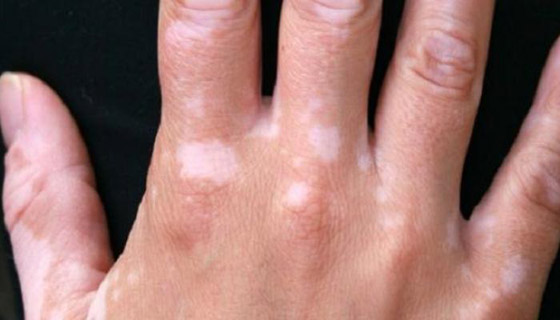 مرض يعاني منه 1% من سكان العالم.. هذه أعراضه وطرق علاجه صورة رقم 3
