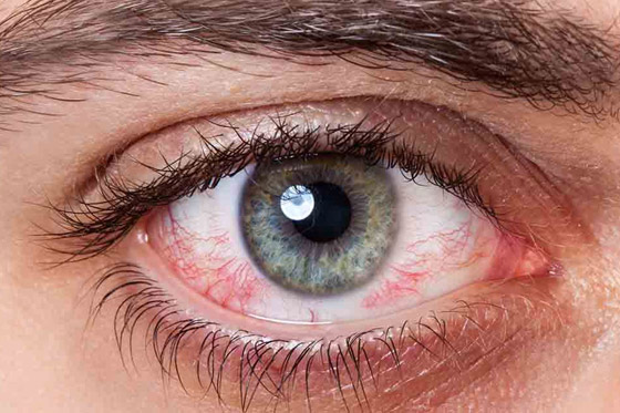 بقعة دم حمراء ظهرت في عينك فجأة؟ إلى ماذا تشير وما أسبابها وعلاجها؟ صورة رقم 8 بقعة دم حمراء ظهرت في عينك فجأة؟ إلى ماذا تشير وما أسبابها وعلاجها؟ صورة رقم 8