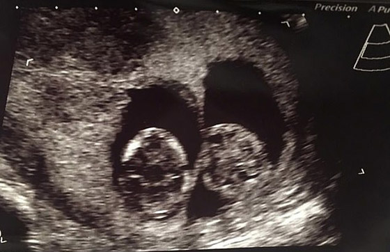 بحالة نادرة لأول مرة.. بريطانية تلد توأمين متماثلين بيومين وكيسين مختلفين! صورة رقم 5