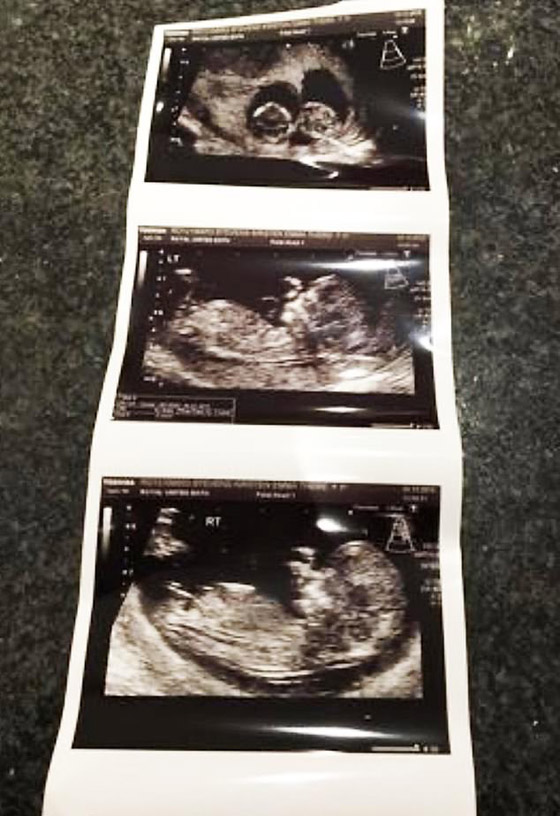 بحالة نادرة لأول مرة.. بريطانية تلد توأمين متماثلين بيومين وكيسين مختلفين! صورة رقم 10