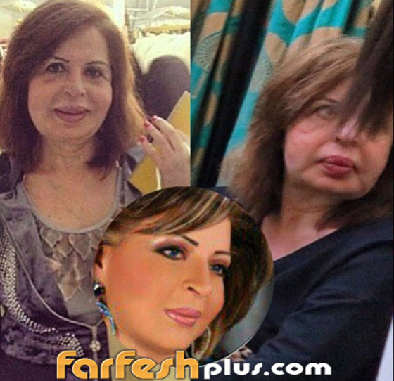 صور صادمة وفيديو: فنانة مصرية تصاب بشلل بعد عملية تجميل صورة رقم 4