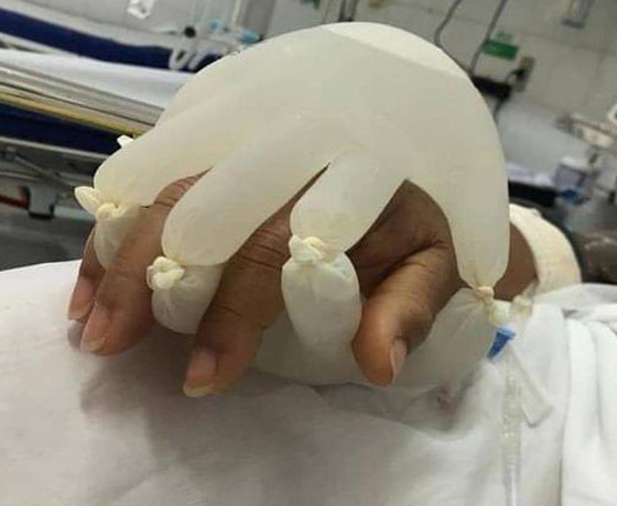 ممرضة برازيلية تبتكر يدا مزيفة تمد مرضى كورونا المعزولين بالدفء! صورة رقم 3