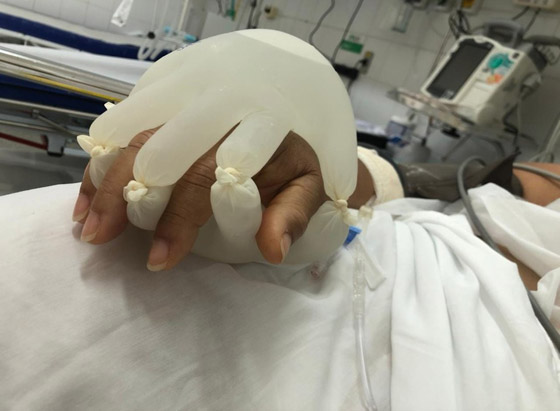 ممرضة برازيلية تبتكر يدا مزيفة تمد مرضى كورونا المعزولين بالدفء! صورة رقم 1