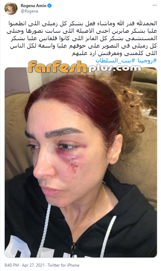 إصابة مروعة لروجينا أثناء تصوير مسلسل (بنت السلطان)! وأول تعليق لها صورة رقم 2