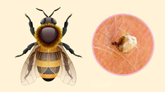 البعوض.. وأشهر الحشرات اللادغة وأعراض الإصابة صورة رقم 2